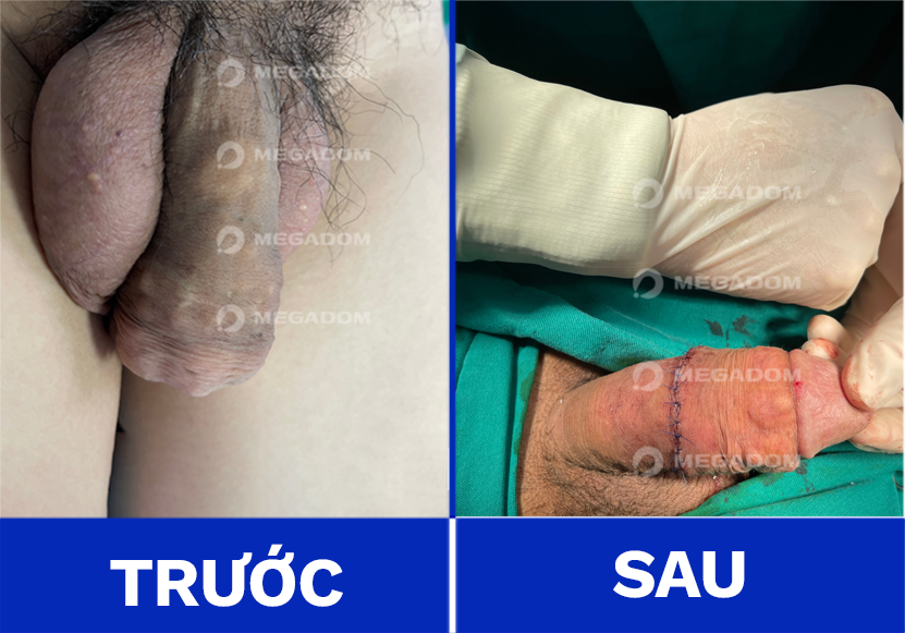 Silicon - anh truoc sau lam to bang silicon