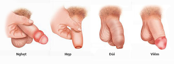 Những bệnh lý thường gặp ở bao quy đầu Những bệnh lý thường gặp ở bao quy đầu