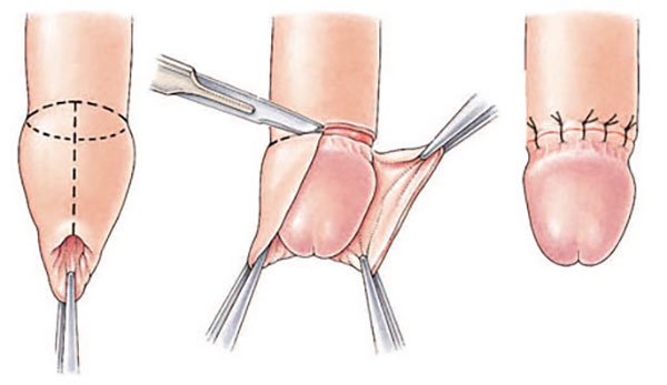 Điều trị hẹp bao quy đầu bằng tiểu phẫu cắt bao quy đầu Điều trị hẹp bao quy đầu bằng tiểu phẫu cắt bao quy đầu